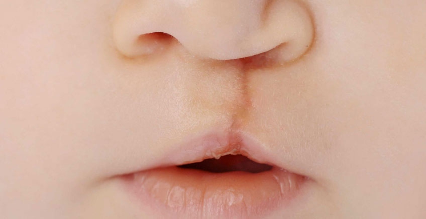 Dudak Damak Yarıklığı Bozuklukları